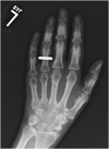 Radiograph:  Left Hand