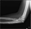 Radiograph:  Left Elbow