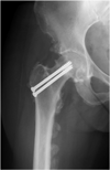 Radiograph:  Left Hip