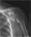 Radiograph:  Left Shoulder