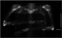 Technetium 99m bone scan
