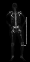 Technetium 99m bone scan
